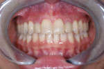 Fig 8. Post-orthodontic treatment, prior to restorative phase.
