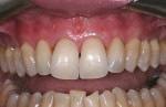 Figure 6  Postoperative view after 12 weeks of healing shows teeth Nos. 5 through 12 to have complete root coverage and a natural appearance.
