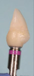 Fig 9. Example of a custom abutment transfer from a different case. Provisional crown/abutment placed on laboratory-analogy.