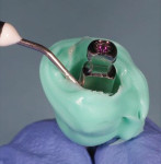 Fig 11. Example of a custom abutment transfer from a different case. Low-viscosity
flowable composite placed in the space that was created by the impression.