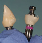 Fig 12. Example of a custom abutment transfer from a different case. Comparison of the custom transfer abutment to the provisional crown/abutment prior to placement into the implant site for final impression.
