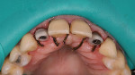 Fig 14. Delivery phase. Moisture control was achieved using retraction of the upper lip with a rubber dam and placement of retraction cord.