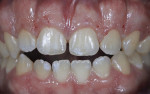 Fig 3. Probing and delimitation performed by marking bleeding points on the gingival margin to be removed.