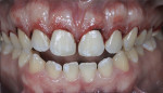 Fig 6. Immediate clinical appearance after finishing gingival contour remodeling with an electric scalpel.