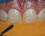 Fig 16. Resin composite applied to the silicone palatal index.
