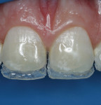 Fig 17. Clinical aspect of the conformation of the palatal shell with the translucent resin composite.