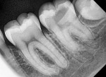 Fig 1. Intraoral periapical radiograph showing caries approximating pulp in left mandibular second molar.