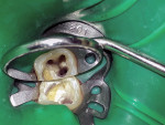 Fig 4. Clinical image showing four separate canal orifices in left mandibular second molar.