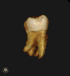 Fig 3. CBCT 3D image, lingual aspect, showing four separate roots of left mandibular second molar.