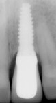 Figure 3  Radiograph demonstrates the 11-year follow-up appearance of the first Laser-Lok implant. Note the crestal bone level at the implant–abutment interface.