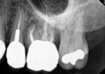 Pretreatment radiograph of teeth Nos. 13 and 14.