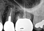Posttreatment radiograph of teeth Nos. 13 and 14 following apical microsurgery.