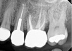 Posttreatment 2-year follow-up radiograph.