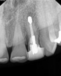 Immediately visible radiographic differences between traditional and modern surgical approaches.