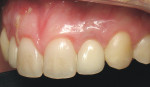 Figure 5  Two-year clinical view of implant replacing tooth No. 10.