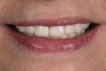 Close-up full smile photograph.