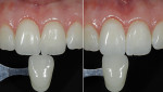 These photographs demonstrate the importance of taking the shade at the beginning of the appointment. The tooth was then isolated with a rubber dam for 30 minutes, and then the rubber dam was removed. The photograph on the right was taken 30 minutes after rubber dam removal, showing the continued dehydration and inaccurate shade.