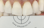 A successful single-tooth restoration, completed with Julian Cardona, CDT.
