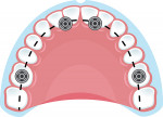 Fig 1. Four-implant A-P distribution in a nonresorbed full-arch fixed case.