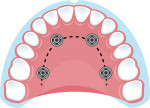 Fig 3. Four-implant A-P distribution in a resorbed full-arch fixed case.