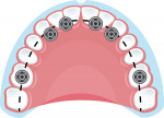 Fig 2. Six implant A-P distribution in a nonresorbed full-arch fixed case.