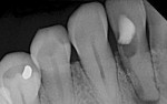 Figure 7  Radiograph demonstrating external resorption and periapical abscess on tooth No. 26.