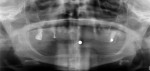 Fig 7. Panoramic radiograph revealed resorbed
maxillary and mandibular alveoli with nonrestorable maxillary dentition.
