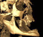 Fig 9. 3D rendering showing highly resorbed maxillary and mandibular alveoli.