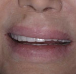 Fig 10. The patient’s maxillary gingiva was not visible in maximum animation, indicating a hidden transition line.