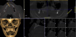 Fig 11. Preoperative CBCT imaging of the premaxilla.