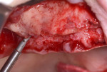 Fig 13. After a flat alveolar surface was prepared, the right posterior implant was placed 2 mm anterior to the anterior maxillary wall. The trajectory of the implants may be evaluated using intraoperative radiographs.