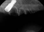 Fig 13. After a flat alveolar surface was prepared, the right posterior implant was placed 2 mm anterior to the anterior maxillary wall. The trajectory of the implants may be evaluated using intraoperative radiographs.
