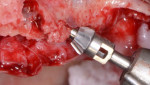 Fig 16. Upon placement of left posterior tilted implant anterior to the anterior maxillary wall, a guide pin was used to guide the bone mill to clear distal bony interference.