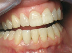 Figure 9  One-year clinical view with ceramo–metal crown on the custom abutment.