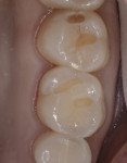 A fissurotomy bur was used to remove the carious lesions and prepare for restoration.