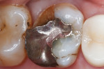 Failing amalgam restoration with fractured distobuccal cusp on upper right first molar.