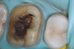 Immediate dentin sealing and final tooth preparation.