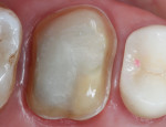 Core reconstruction using self-etch bonding technique with a light-cured dental adhesive and a nanohybrid universal composite.
