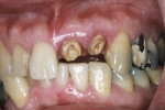Figure 11  Clinical photograph showing a horizontal fracture of crowns on teeth Nos. 9 and 10 after root canal treatment and post placement.