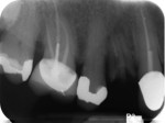 Fig 6. Pretreatment radiograph of the remaining root tip at maxillary right first premolar.