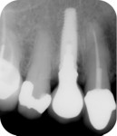Fig 9. Radiograph of final screw-retained prosthesis.