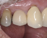 Fig 10. Buccal view of final screw-retained prosthesis.