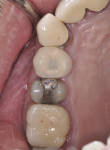 Fig 11. Occlusal view of final screw-retained prosthesis.