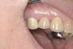 Fig 17. Buccal view of the final crown in place.