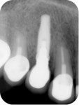 Fig 18. Radiograph of the definitive screw-retained restoration.