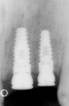 Figure 13  Immediate postsurgical placement of BioHorizons Laser-Lok Tapered Internal Implants (No. 9 with a 4.5-mm platform and No. 10 with a 3.5 mm platform) placed as a single-stage protocol with transgingival healing abutments.
