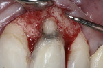 Fig 5. GIC placed into root perforation as sealant material.