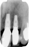 Figure 14  Two-year posttreatment radiograph demonstrating crestal bone stability compared to initial radiographs. Bone levels approximate the most coronal level of the Laser-Lok microchannels.