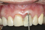 Fig 6. Six months after surgical intervention, periodontal examination revealed presence of suppuration.
