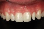 Preoperative frontal view of peg-shaped lateral incisors Nos. 7 and 10.